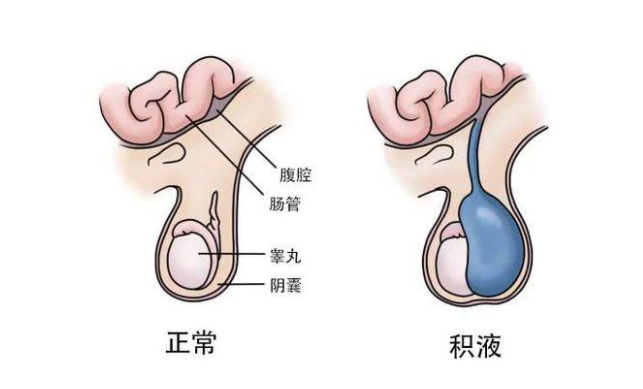 宝宝“蛋蛋”明显肿大怎么回事？